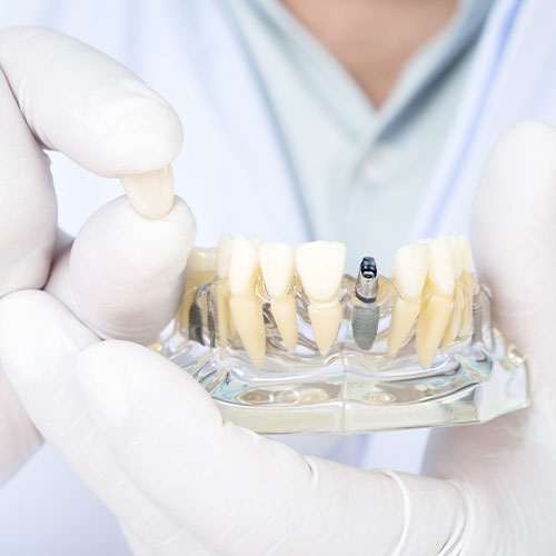 ZA Schwarzfischer Bild Implantate
